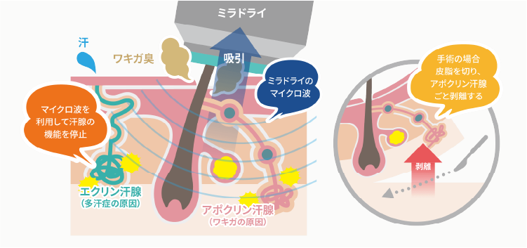 切らずに1日で治療ができる医療機器 miraDry